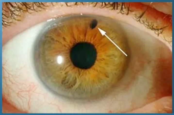 Eye examination