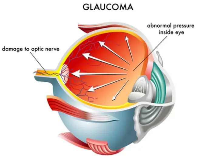 Glaucoma optic nerve diagram