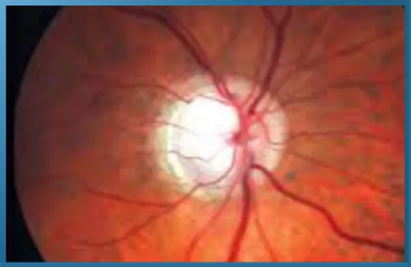 Fundus photograph
