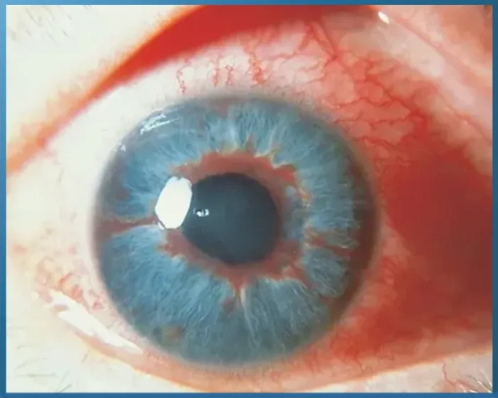 Red eye