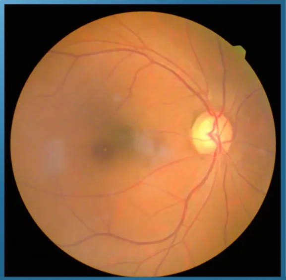 Fundus photograph