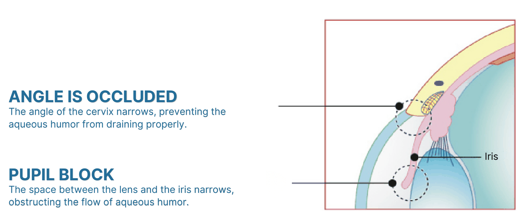 Laser iridotomy step 1