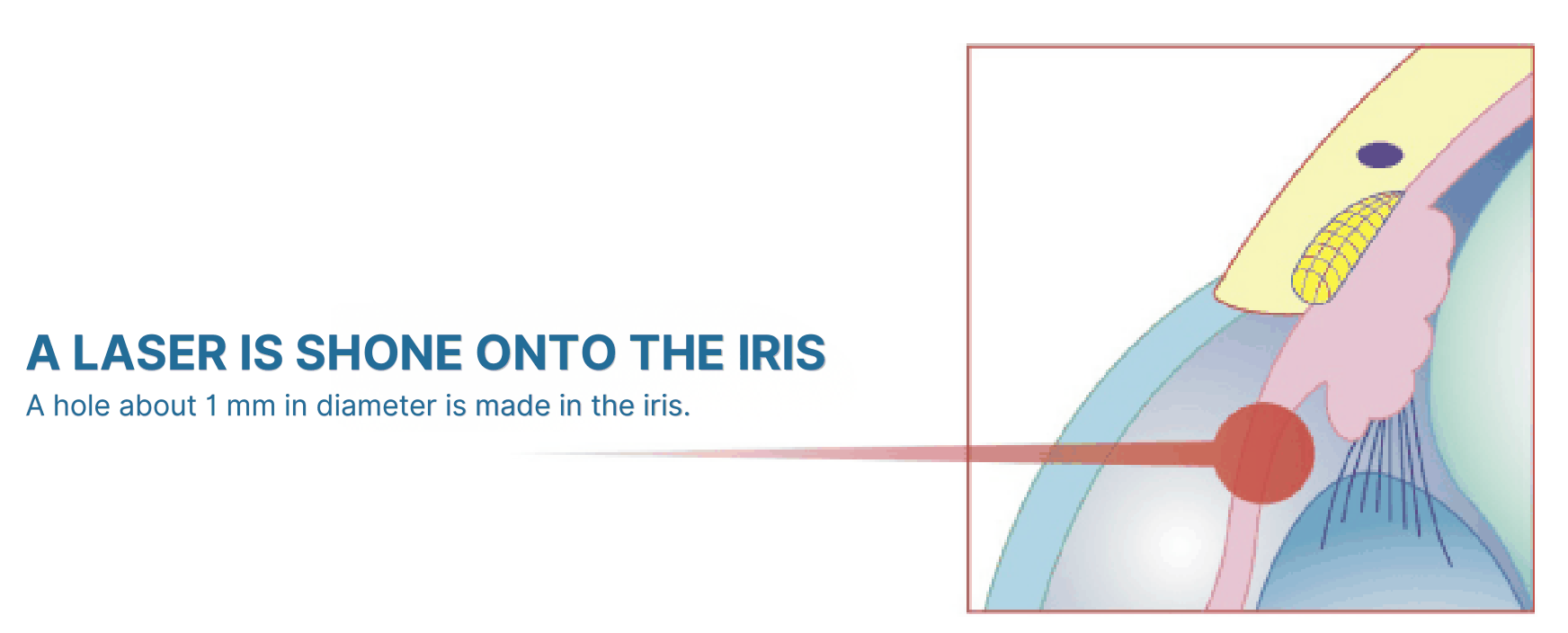 Laser iridotomy step 2