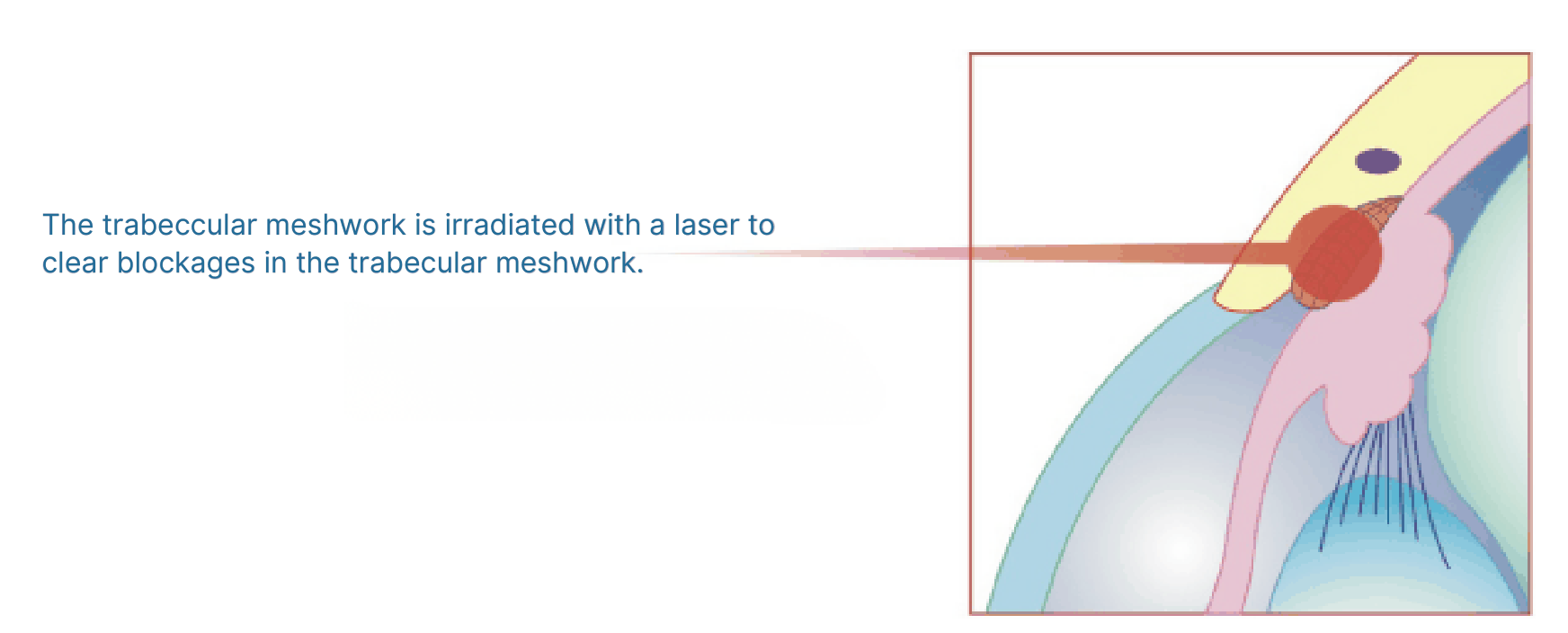 Laser trabeculoplasty step 2