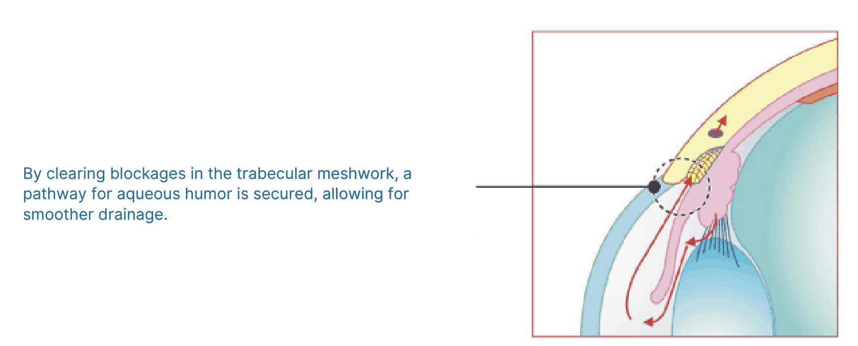 Laser trabeculoplasty step 3