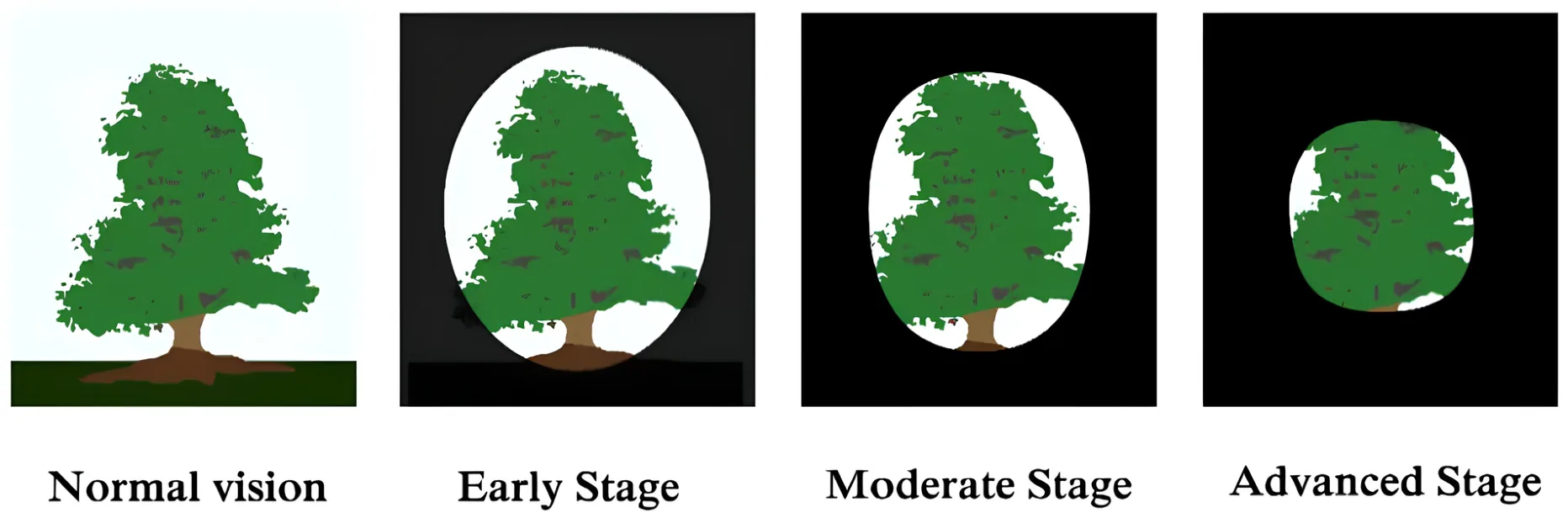 Progression of visual field loss due to glaucoma
