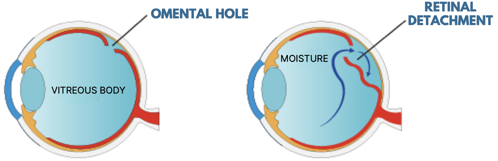 Retinal tear leading to retinal detachment