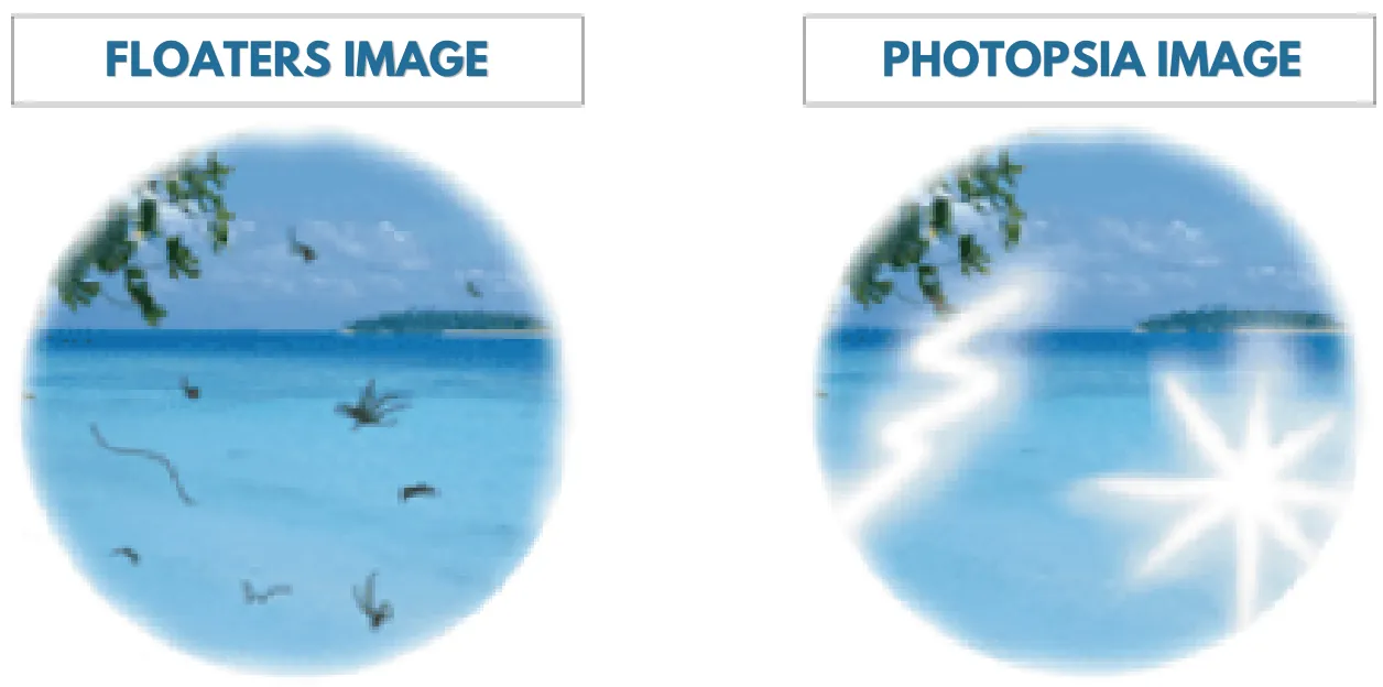 Floaters image and photopsia image