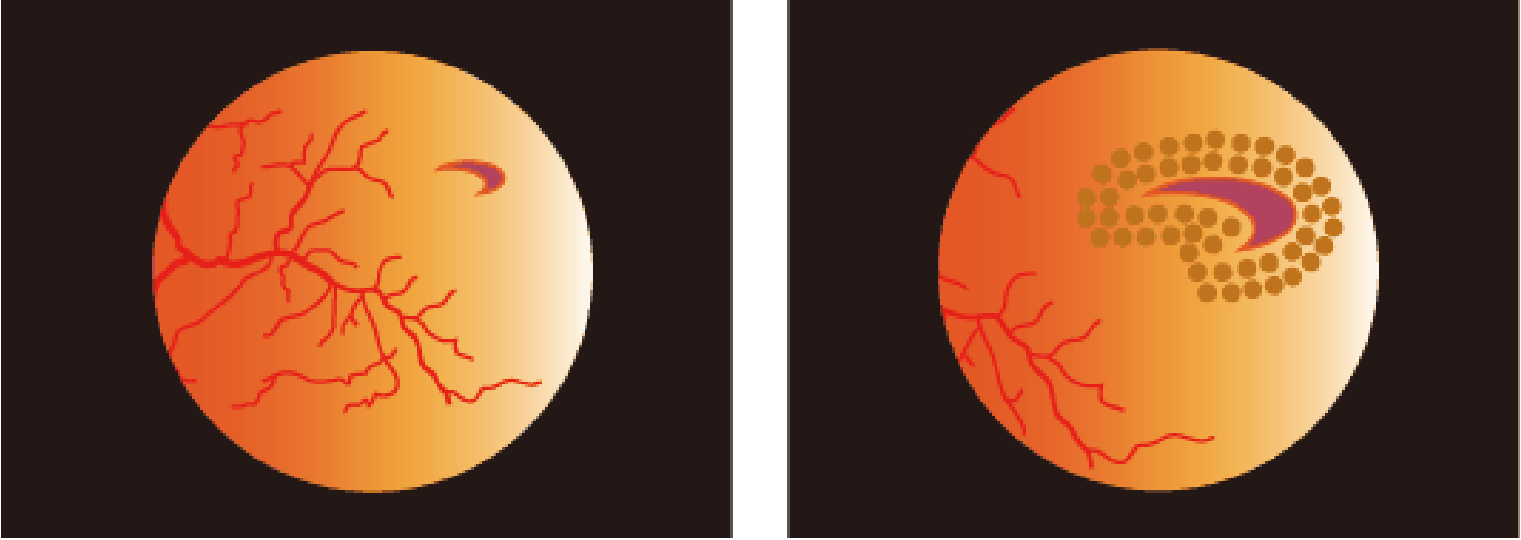Tear in retina and area sealed with a laser