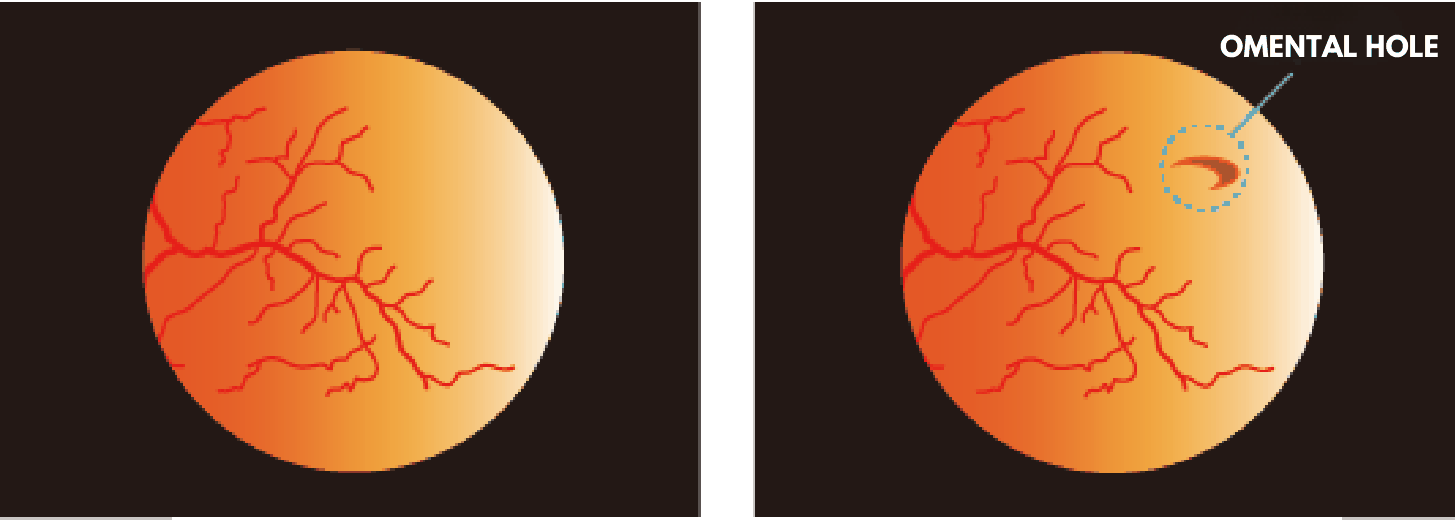 Normal retina and retina with a tear
